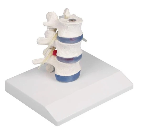 Vértebras lumbares con discos intervertebrales prolapsados con soporte