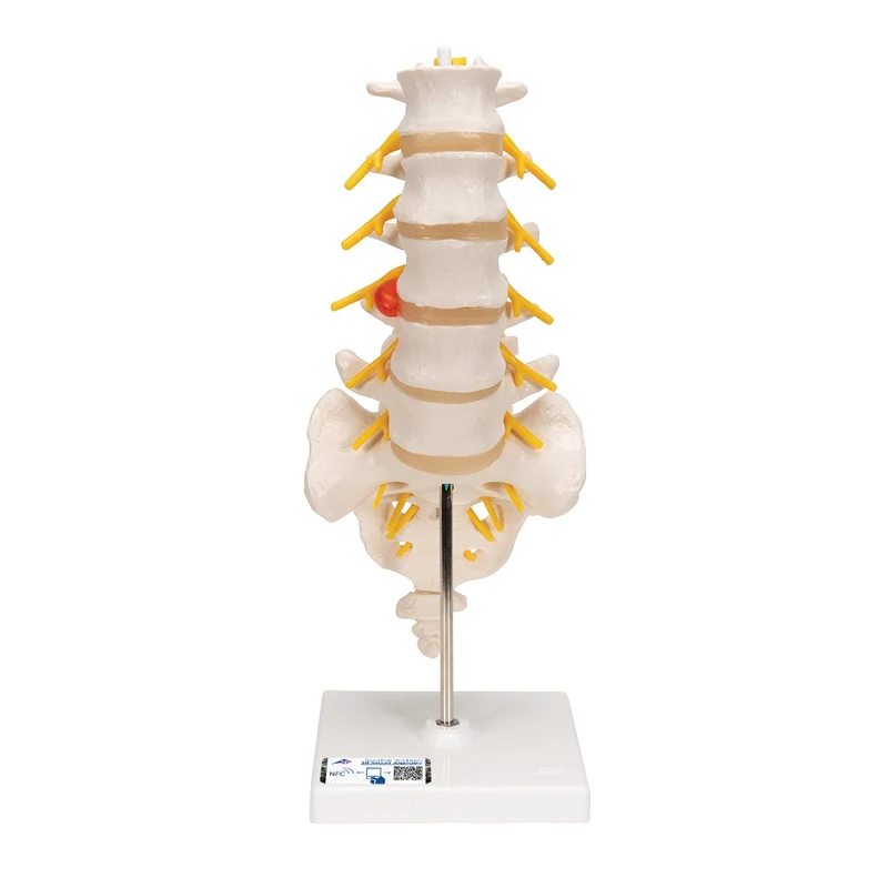 Columnavertebral lumbar con hernia discal dorsolateral - 3B Smart Anatomy